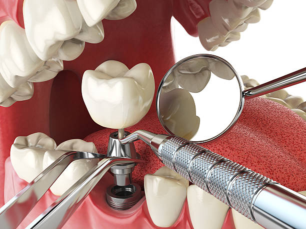 Best Emergency Tooth Extraction in Urania, LA